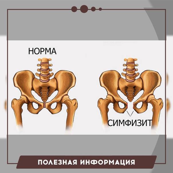 Симфизит во время беременности