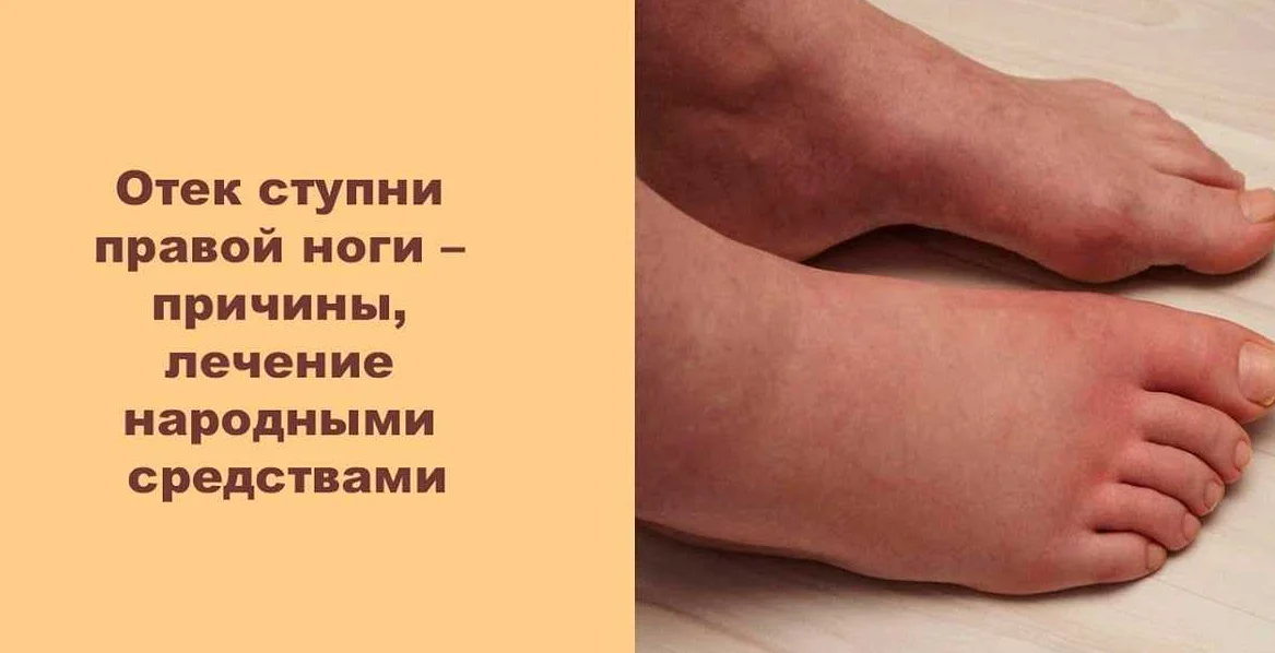 Отеки при беременности
