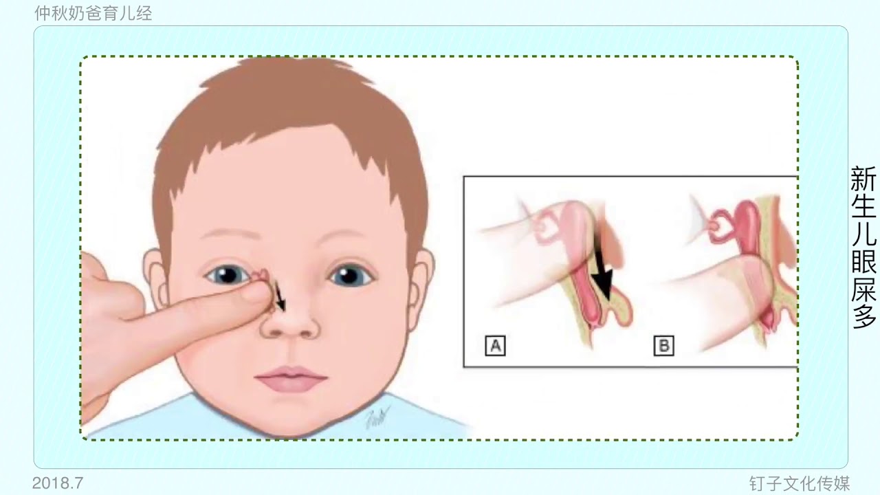 Показания к назначению массажа слезного канала у новорожденных и как правильно делать