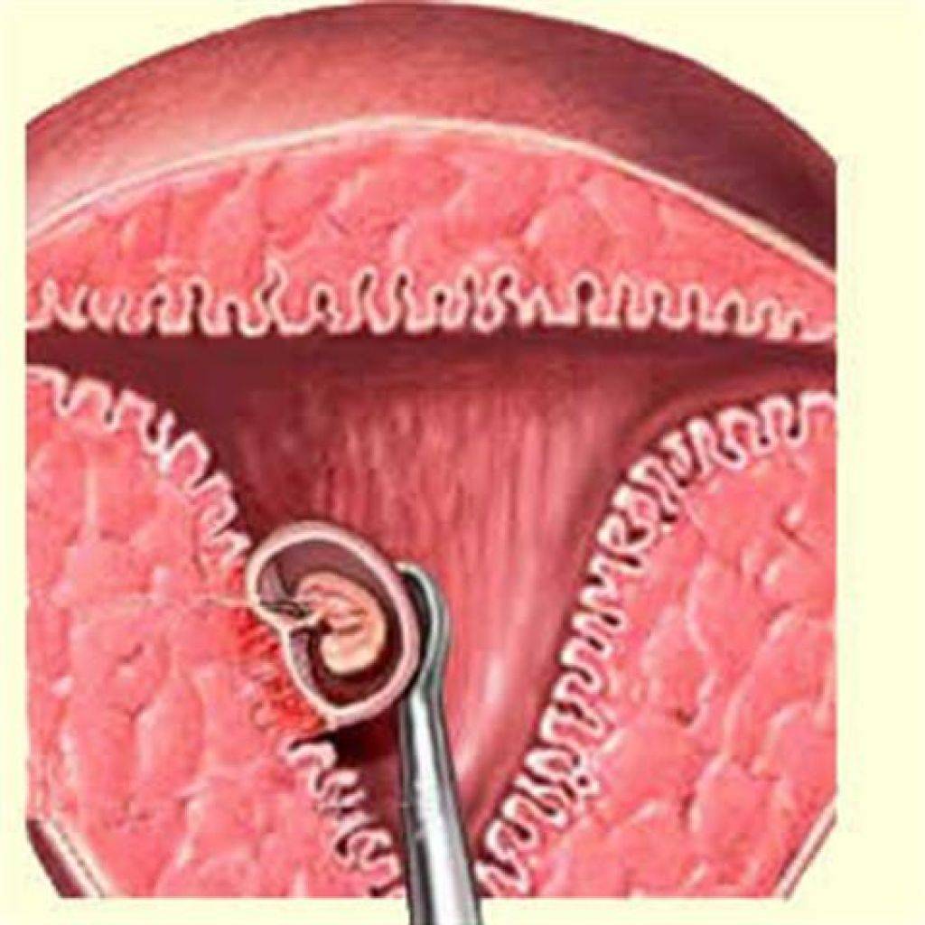 Операция по удалению эндометрия матки. Выскабливание слизистой оболочки матки. Выскабливание плацентарной полипа. Выскабливание эндометрия. Выскабливание полости матки беременности.