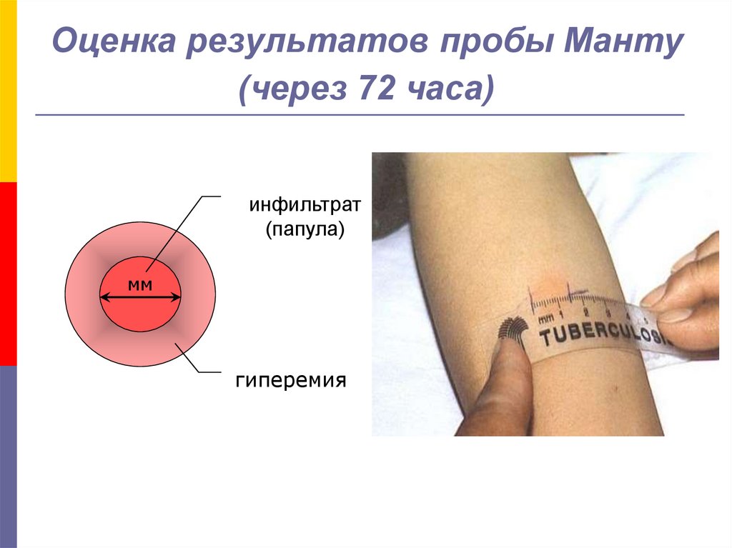 Как правильно мерить манту с фото Реакция манту: когда и кому ставится, оценка туберкулиновой пробы