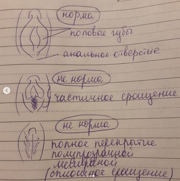 Синехии крайней плоти у мальчиков и методы их лечения