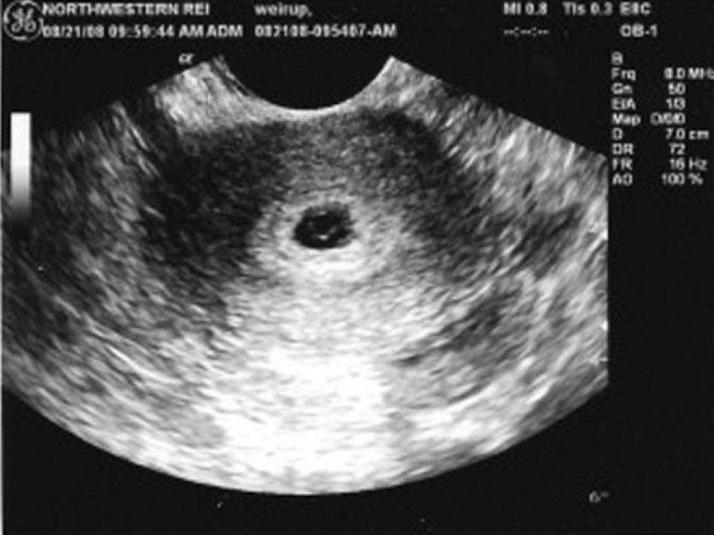 Неделя после зачатия узи. УЗИ беременности 4 недели беременности. УЗИ на 2-4 недели беременности. УЗИ на 5 неделе беременности с неправильной формой плодного яйца. УЗИ беременности по неделям 4 недели.