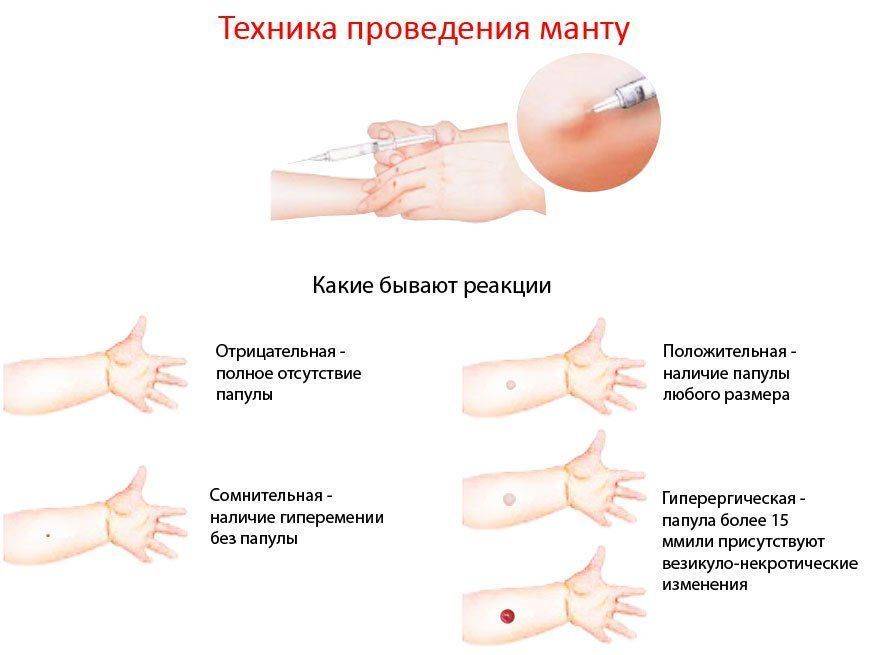 Можно ли делать манту, если ребенок болеет: влияние на результаты
