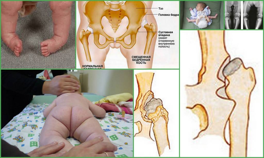 Узи диагностика тазобедренных суставов (тбс) у детей — нормы углов и типы отклонений