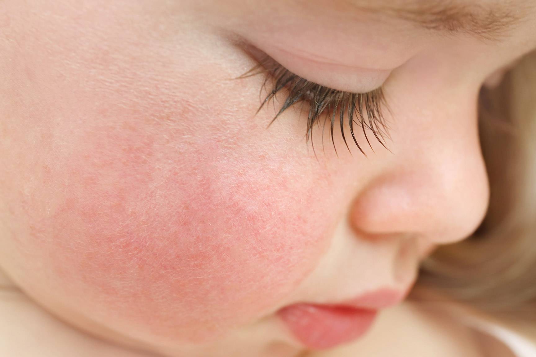 Сухие пятна или шершавая кожа у ребенка – от чего может шелушиться и сохнуть кожа малыша?