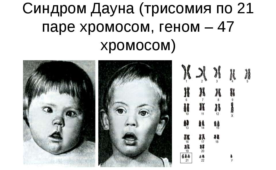 Признаки синдрома дауна у новорожденных: как определить болезнь, симптомы