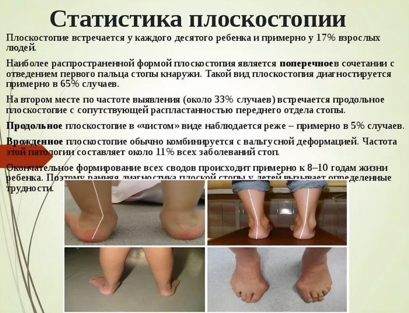 Диагностика плоскостопия у детей - страна мам