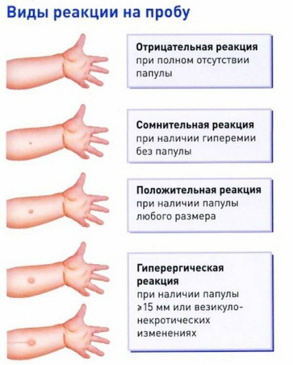 Можно ли ставить манту ребенку при насморке и простуде