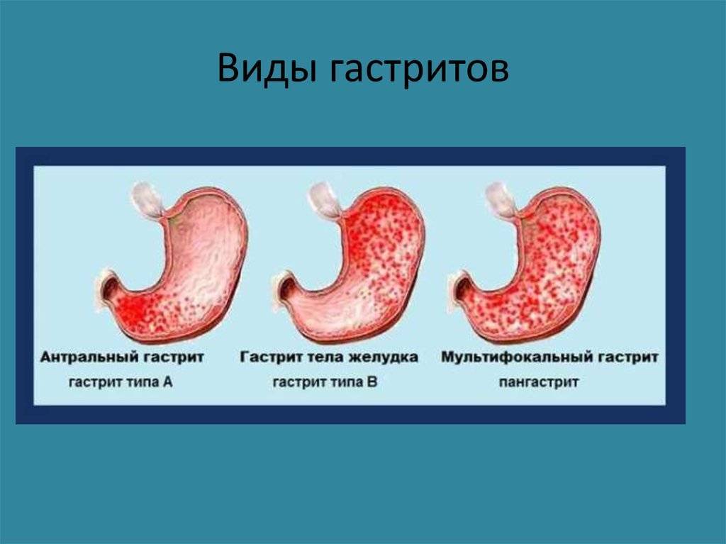 Лечение хеликобактер пилори при грудном вскармливании. гастрит желудка у кормящих мам