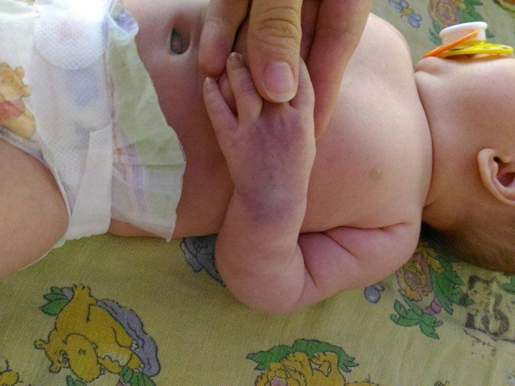 Монгольское пятно у новорожденного: что означает, причины появления, лечение
