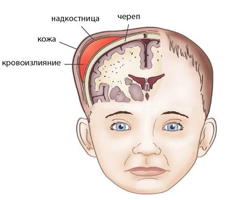 Лечение и последствия кефалогематомы у новорожденных