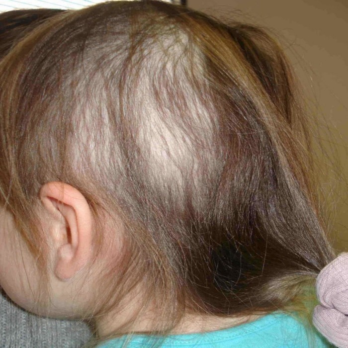 Почему у новорожденного грудничка выпадают волосы на голове: естественные и патологические причины