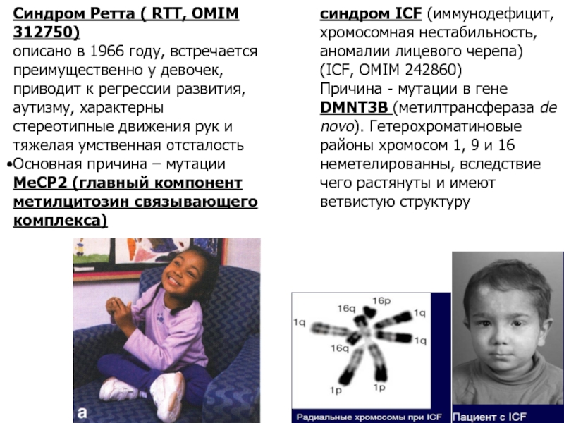Синдром ретта