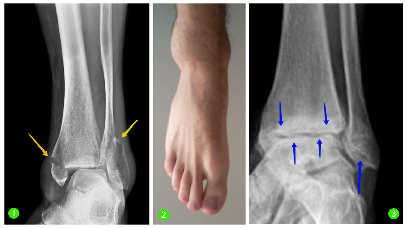 Апикальный перелом латеральной лодыжки — вопрос №570594