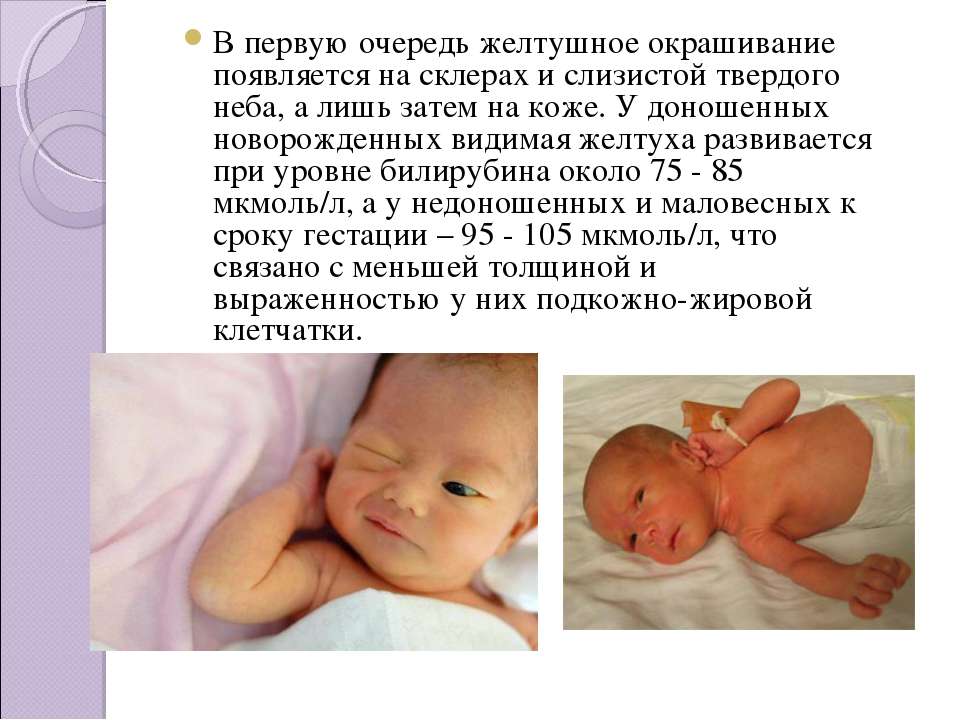 Физиологическая желтуха у новорожденных: когда, как долго, через сколько должна пройти? узнайте из нашей статьи!