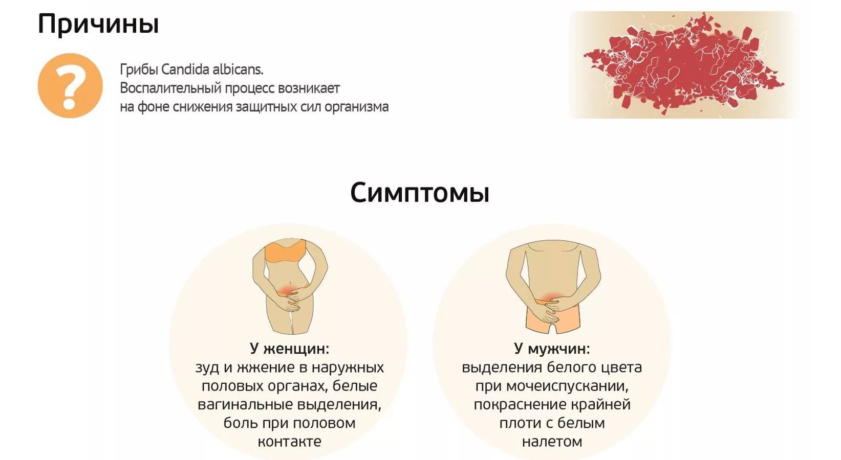 Вагинит слова. Молочница у женщин симптомы.