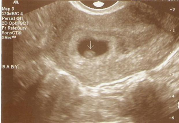 3 недели беременности от зачатия: что происходит, признаки, ощущения, как выглядит зародыш, эмбрион, симптомы