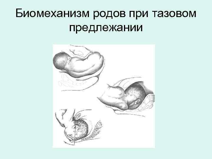 Как перевернуть ребенка из тазового в головное предлежание?