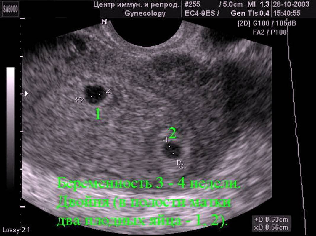 Неделя после зачатия узи. УЗИ на 5 неделе беременности двойня. УЗИ беременность 2 плодных яйца. УЗИ 3 недели беременности двойня. Как выглядит эмбрион в 5-6 недель на УЗИ.