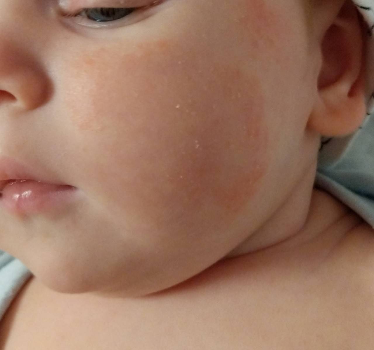 Шершавые пятна на теле у ребенка: как лечить сухие красные или розовые высыпания на коже?