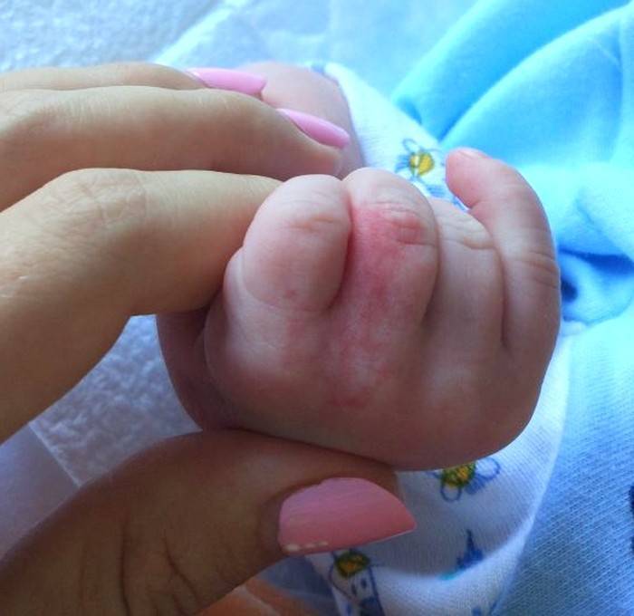 Почему гноится глаз у новорожденного и как его лечить максимально эффективно