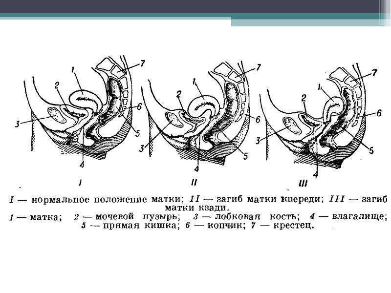 Как устроена матка. Матка накклонена к зади. Беременность при загибе матки кзади.