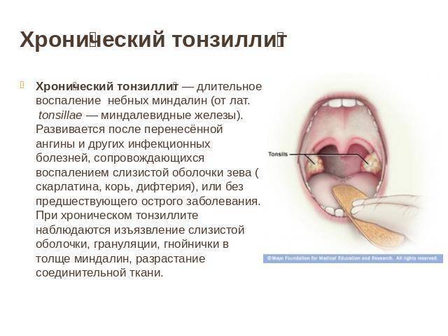 Как лечить миндалины в горле у ребенка:увеличенные миндалины