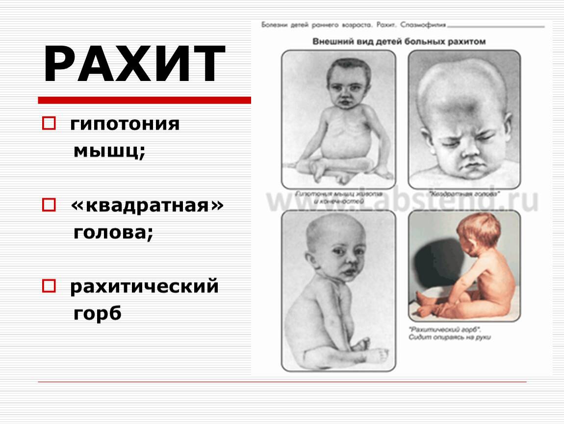 Рахит у грудничков (новорожденных): 10 признаков, 9 причин, симптомы, лечение, профилактика
