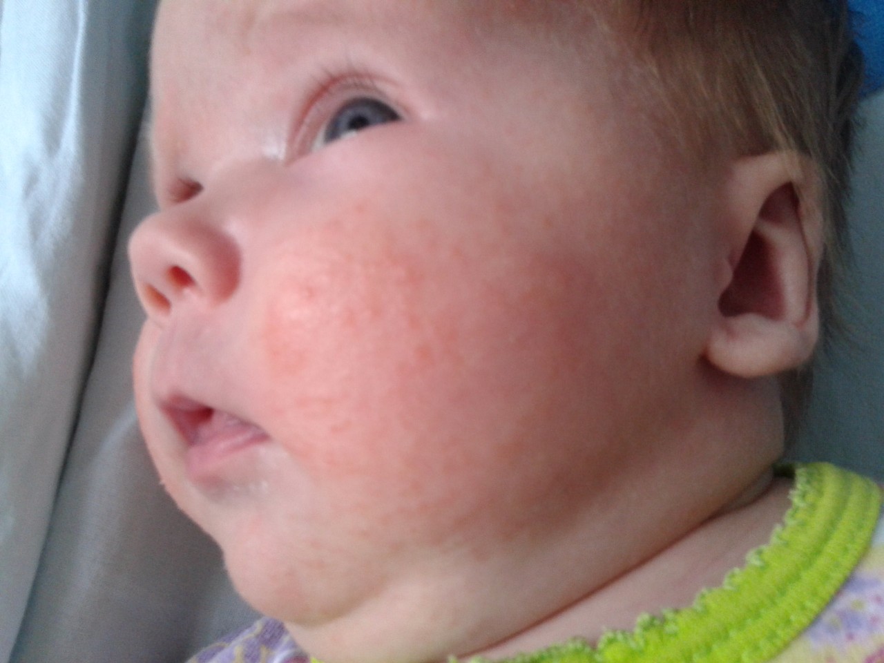 Красные прыщики на лице у новорожденного: причины и способы лечения