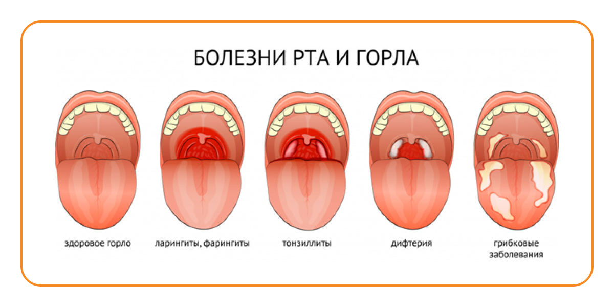 Острый и хронический тонзиллит у детей