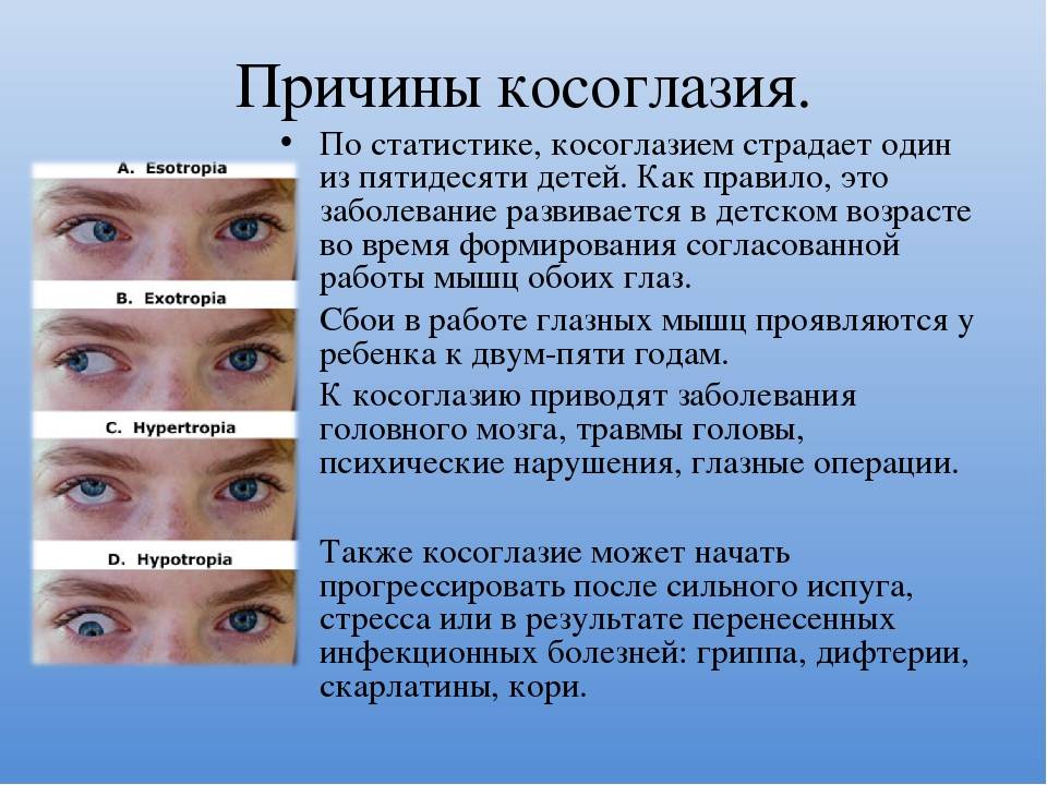 Косоглазие у новорожденных: причины, когда проходит?