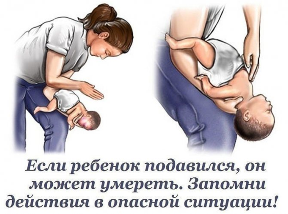Прием геймлиха беременным. Если ребёнок подавился что делать первая помощь и задыхается. Что делать если ребенок подавился. Если ребенок поперхнулся.