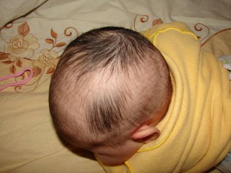 Почему у новорожденного грудничка выпадают волосы на голове: естественные и патологические причины