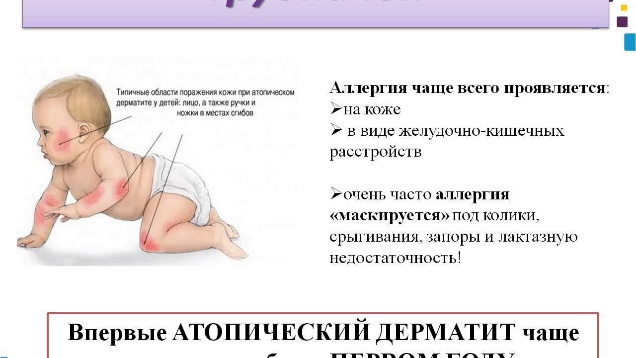 Как проявляется аллергия у новорожденных при грудном вскармливании - agulife.ru