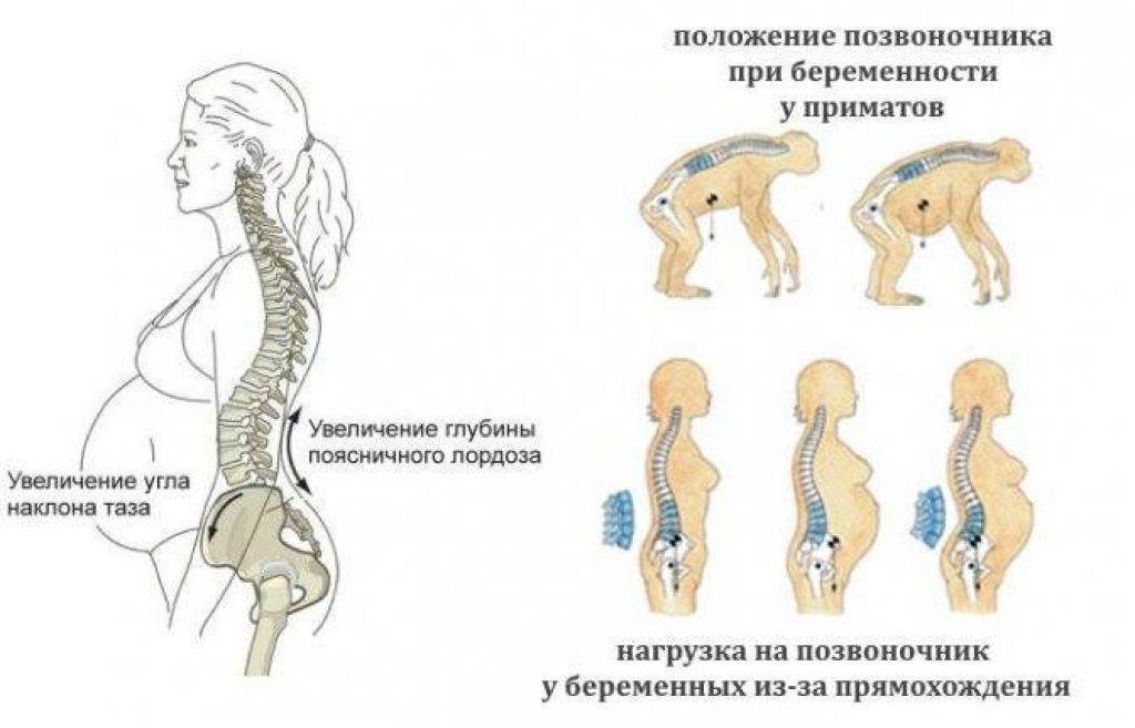 Боли в спине при беременности
