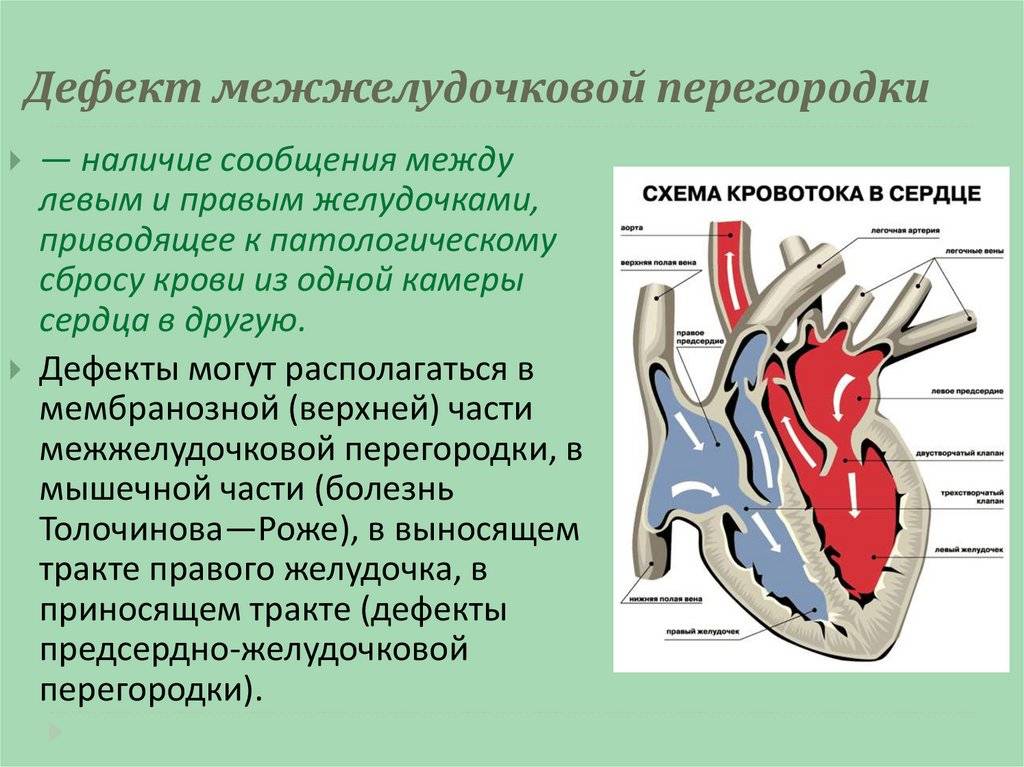 Межжелудочковая перегородка. Некоммитированный дефект межжелудочковой перегородки. Межжелудочковая перегородка сердца. Дефект межжелудочковой перегородки сердца. Дефект мышечной части межжелудочковой перегородки.