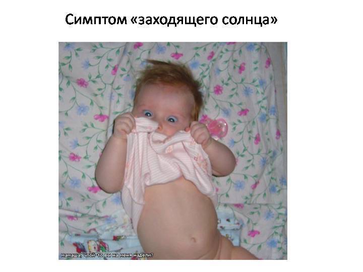 Синдром грефе: симптомы, причины, лечение