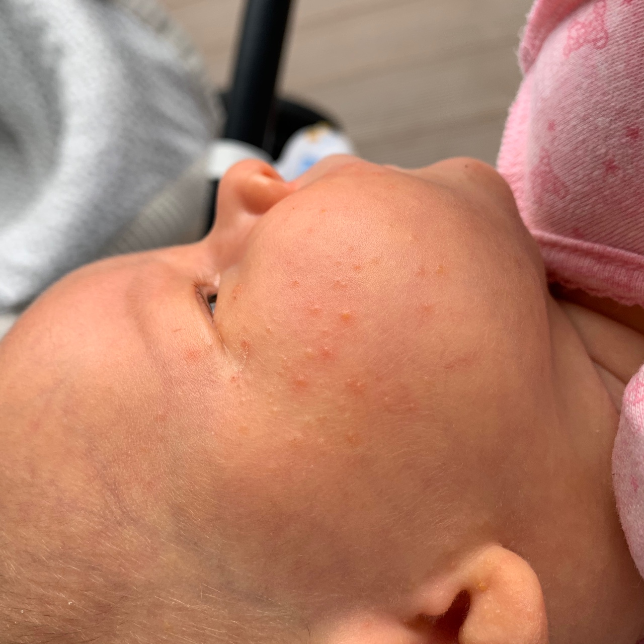 Прыщики на лице у новорожденного: откуда появляются и как от них избавиться?