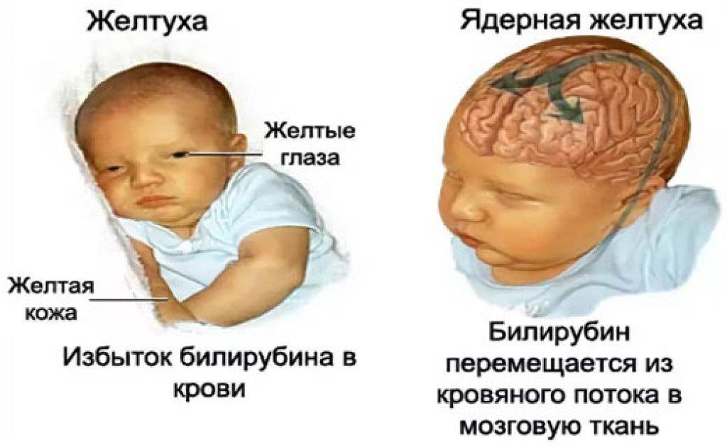 Перинатальная энцефалопатия