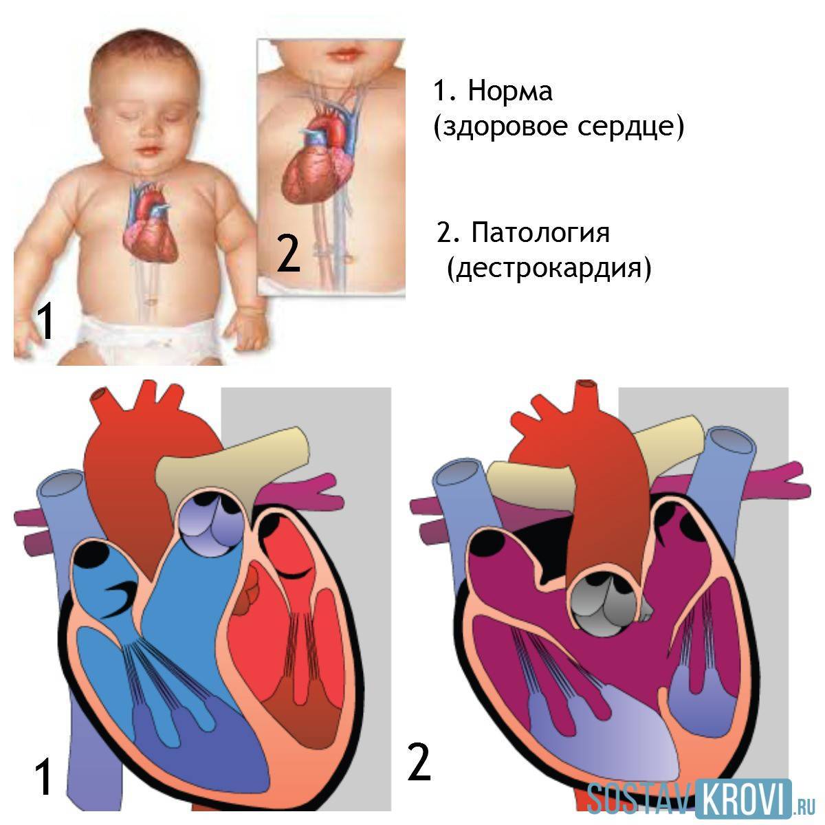 Пороки сердца врожденные и приобретенные: диагностика и лечение