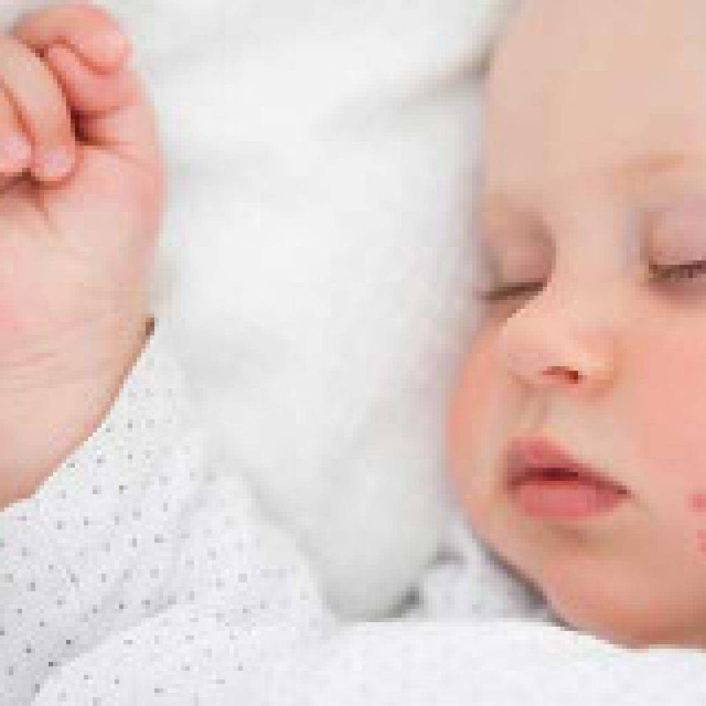 Герпес у ребенка | причины, симптомы и лечение герпеса у ребенка