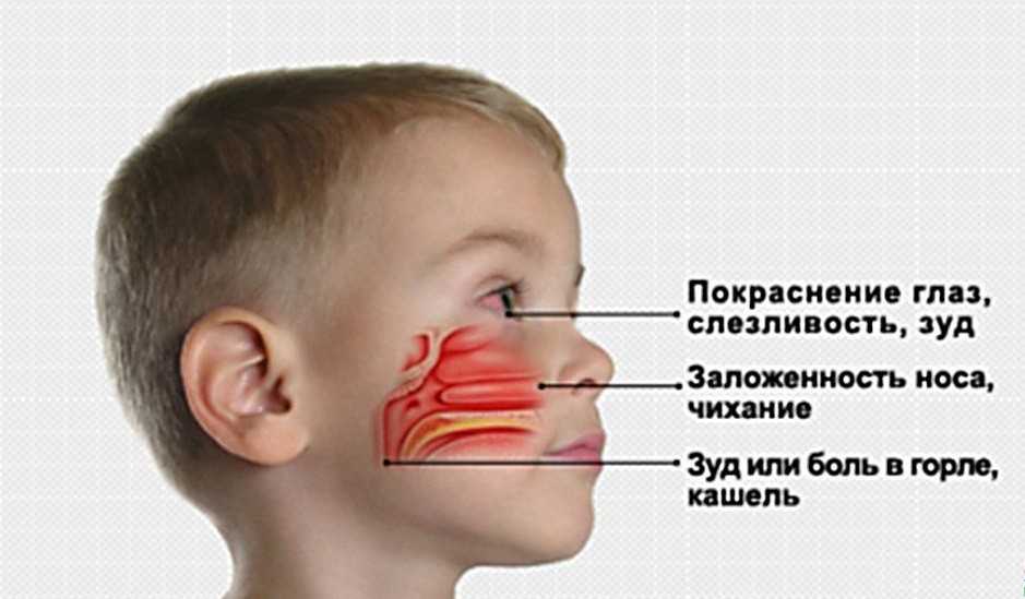 Насморк у ребенка: причины и лечение