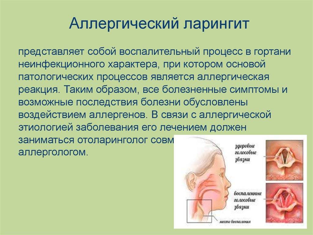 Ларингит у детей: симптомы и лечение в домашних условиях