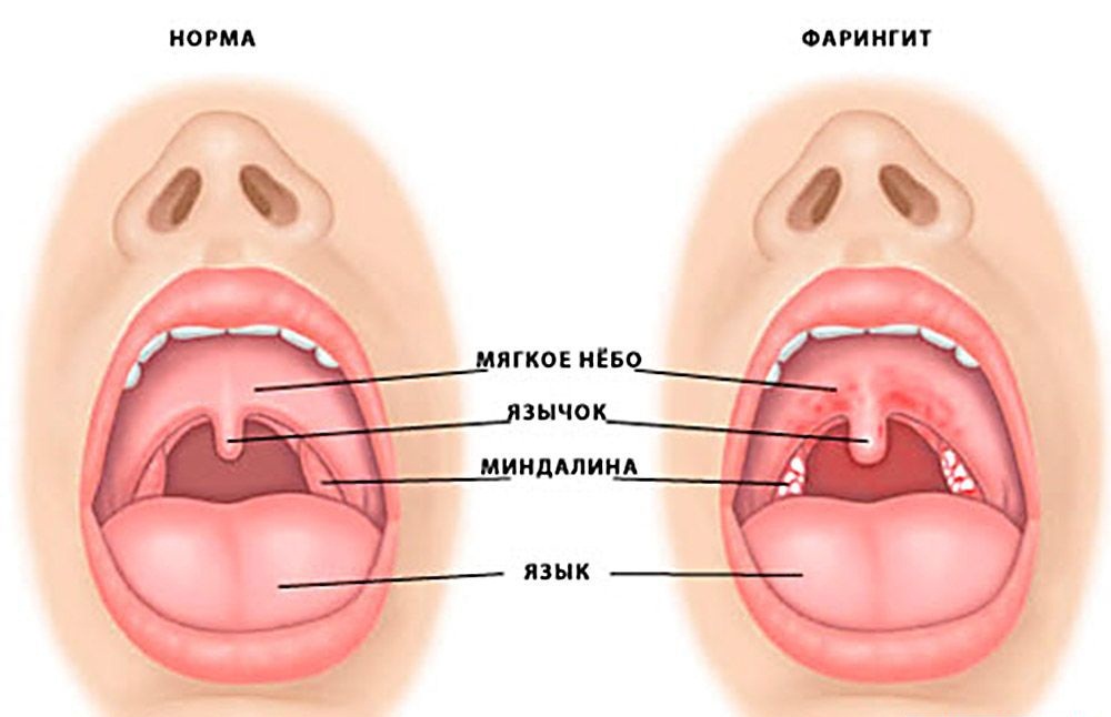 Чем лечить горло кормящей маме: разрешенные таблетки, процедуры и режим лактации