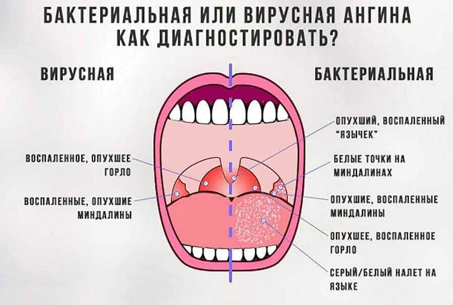 Лечение стоматита у детей