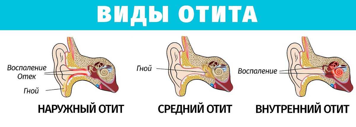 Болит ухо чем лечить при грудном вскармливании