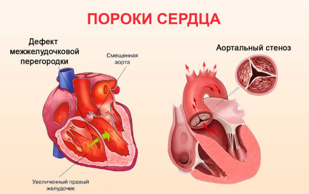 Порок сердца у новорожденных: причины, симптомы и лечение