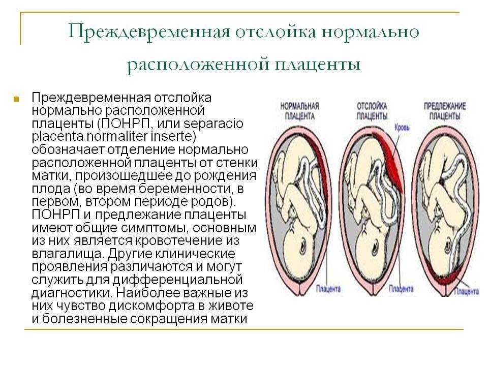 Преждевременная отслойка плаценты презентация