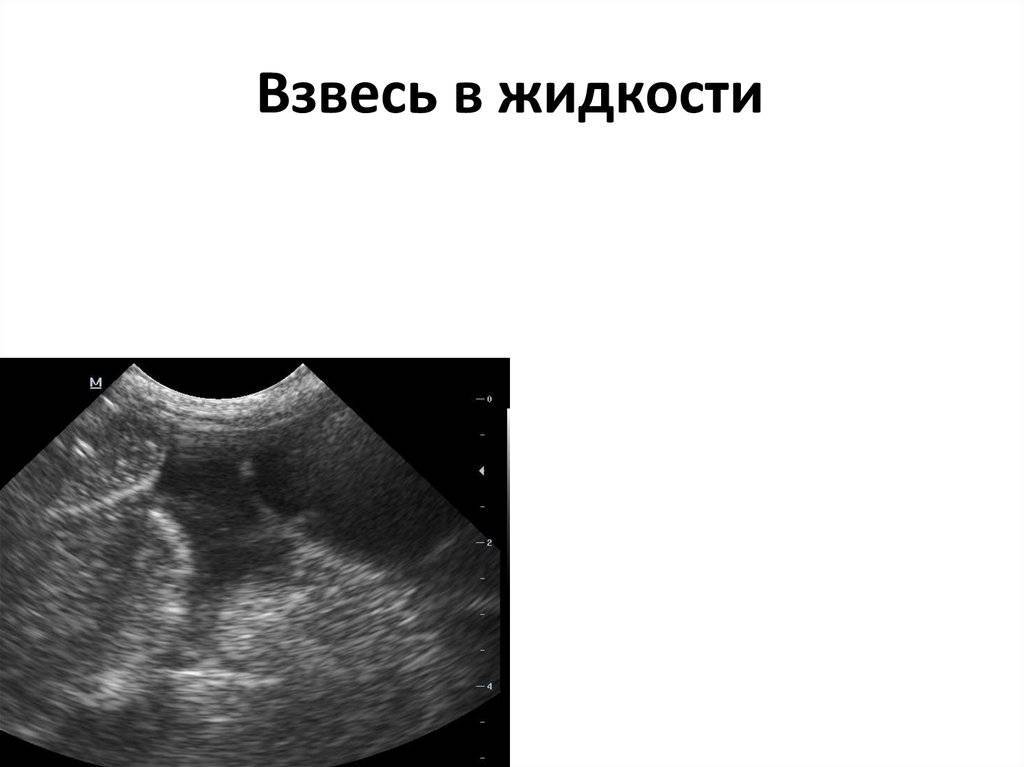 Взвеси в околоплодных водах может быть от молочницы